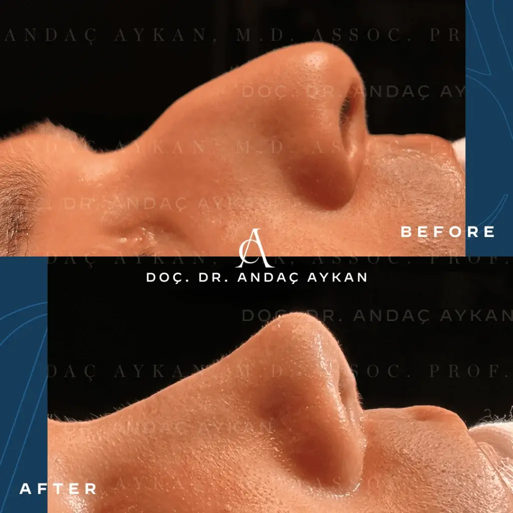 Burun Estetiği